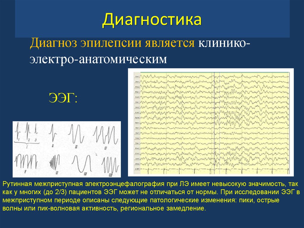 Диагноз эпилепсия