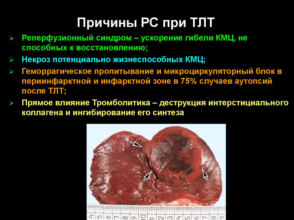 Причины РС при ТЛТ