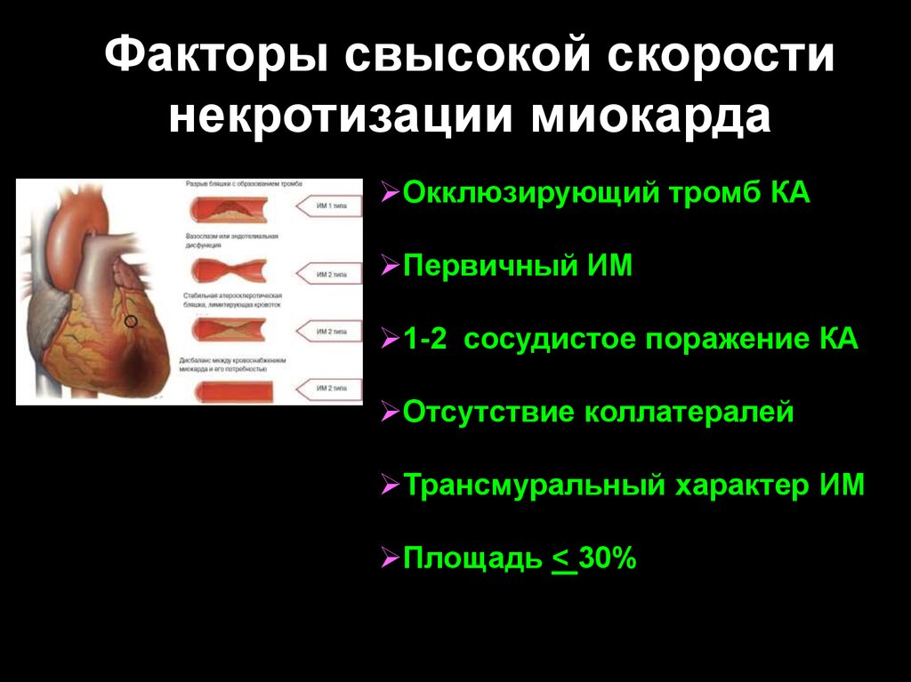 Факторы свысокой скорости некротизации миокарда