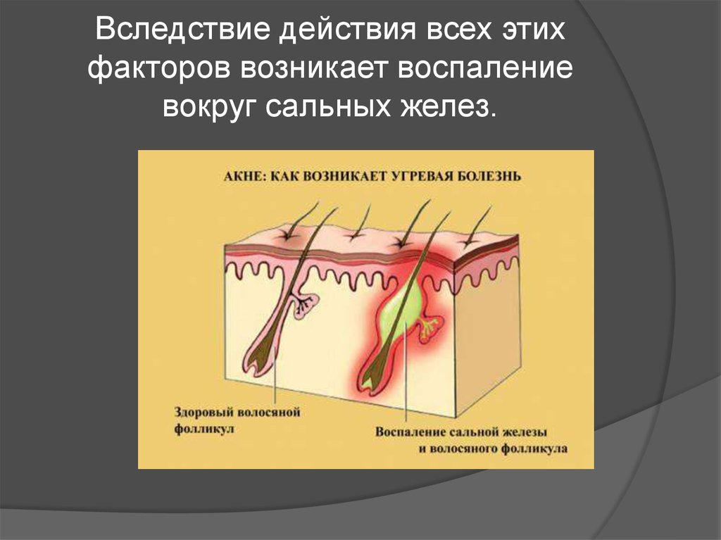 Повышенные сальные железы. Воспаление сальной железы. Воспалилась сальная железа. Воспаление протоков сальных желез. Закупоренная сальная железа.