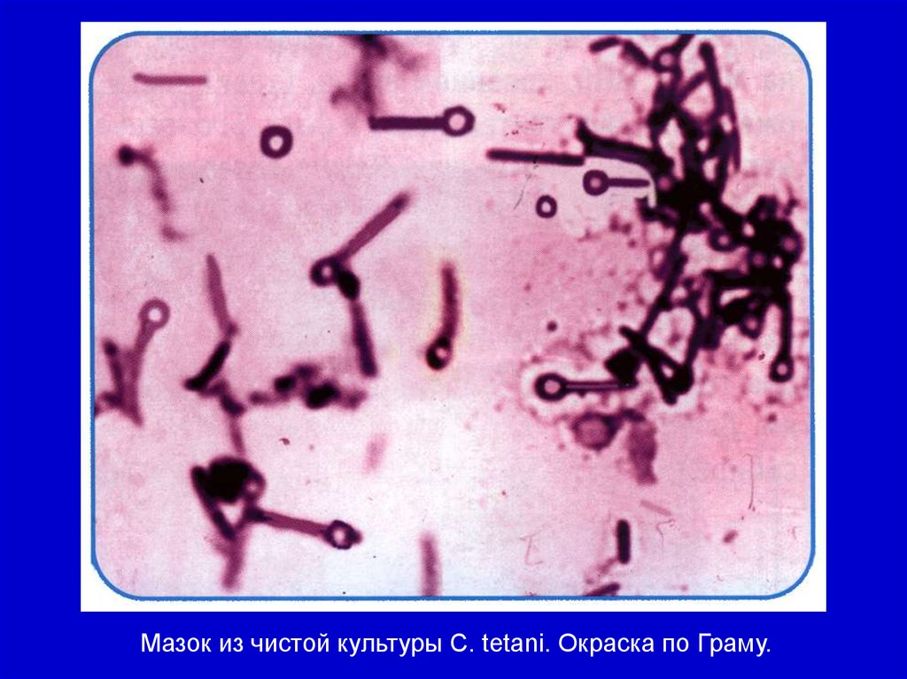 Возбудитель столбняка. Мазок клостридии столбняка. Столбнячная палочка Clostridium tetani. Возбудитель столбняка Clostridium tetani это. Клостридии ботулизма окраска по Граму.