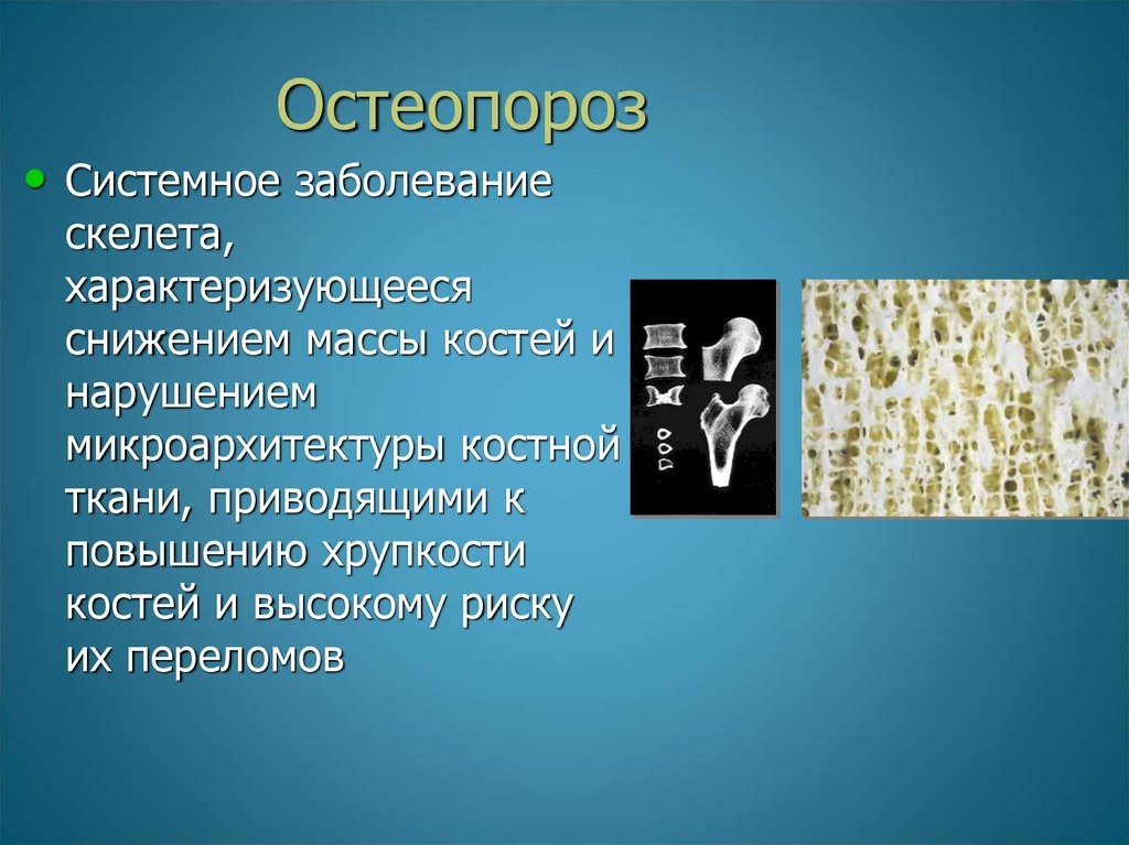 Презентация по теме остеопороз