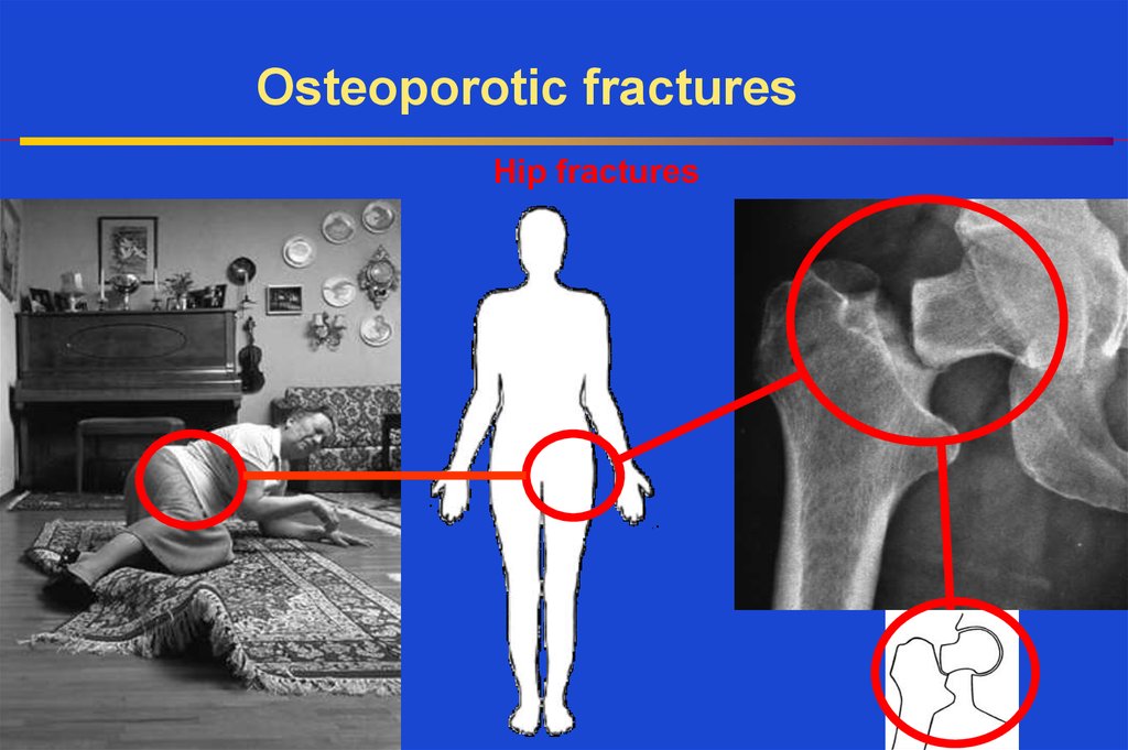 Osteoporosis Diagnosis And Treatment Online Presentation