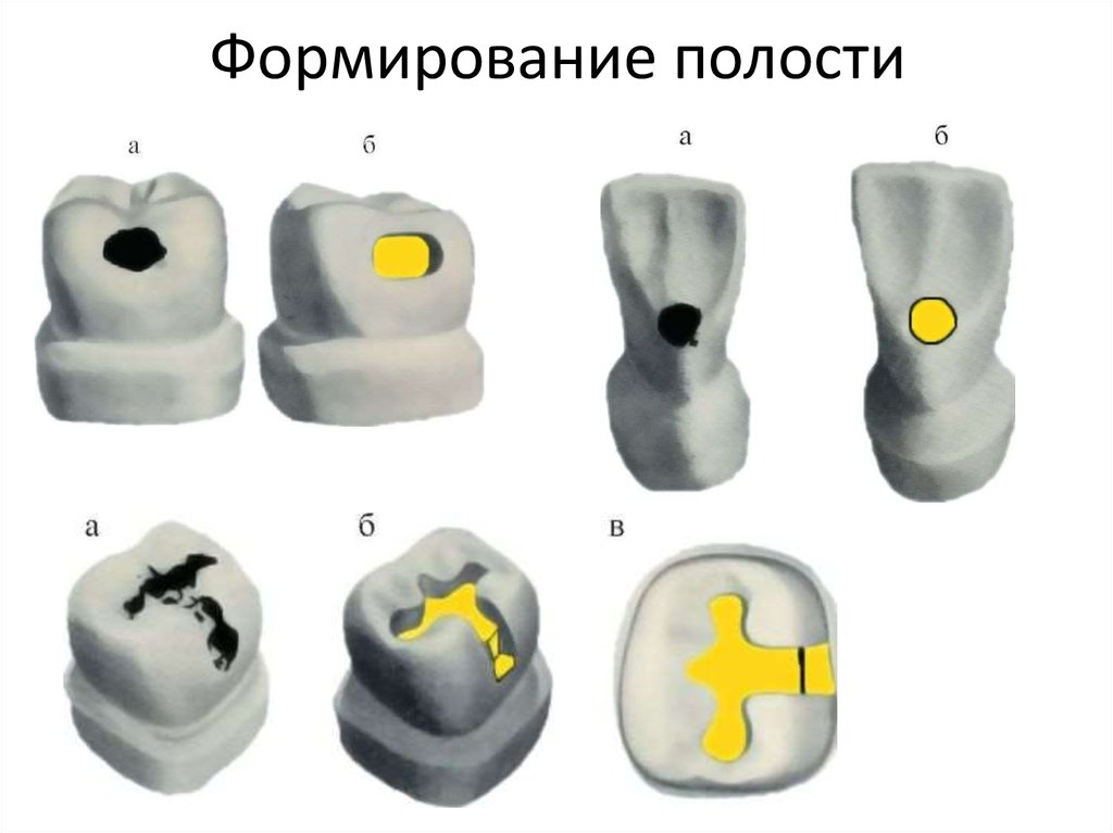 V класс по блэку. Этапы препарирования 1 класса по Блэку. Препарирование полостей 1 класса по Блэку. Формирование кариозной полости 1 класса по Блэку. Формирование полостей зубов по Блэку.