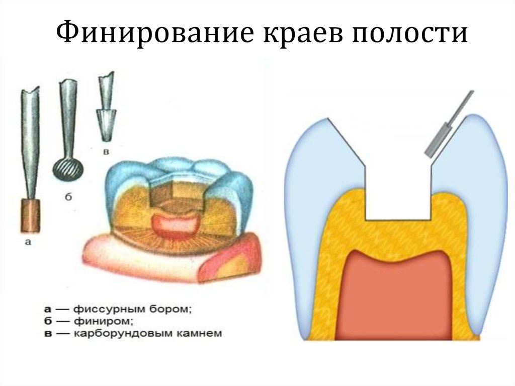 Особенности препарирования кариозных полостей по блэку презентация