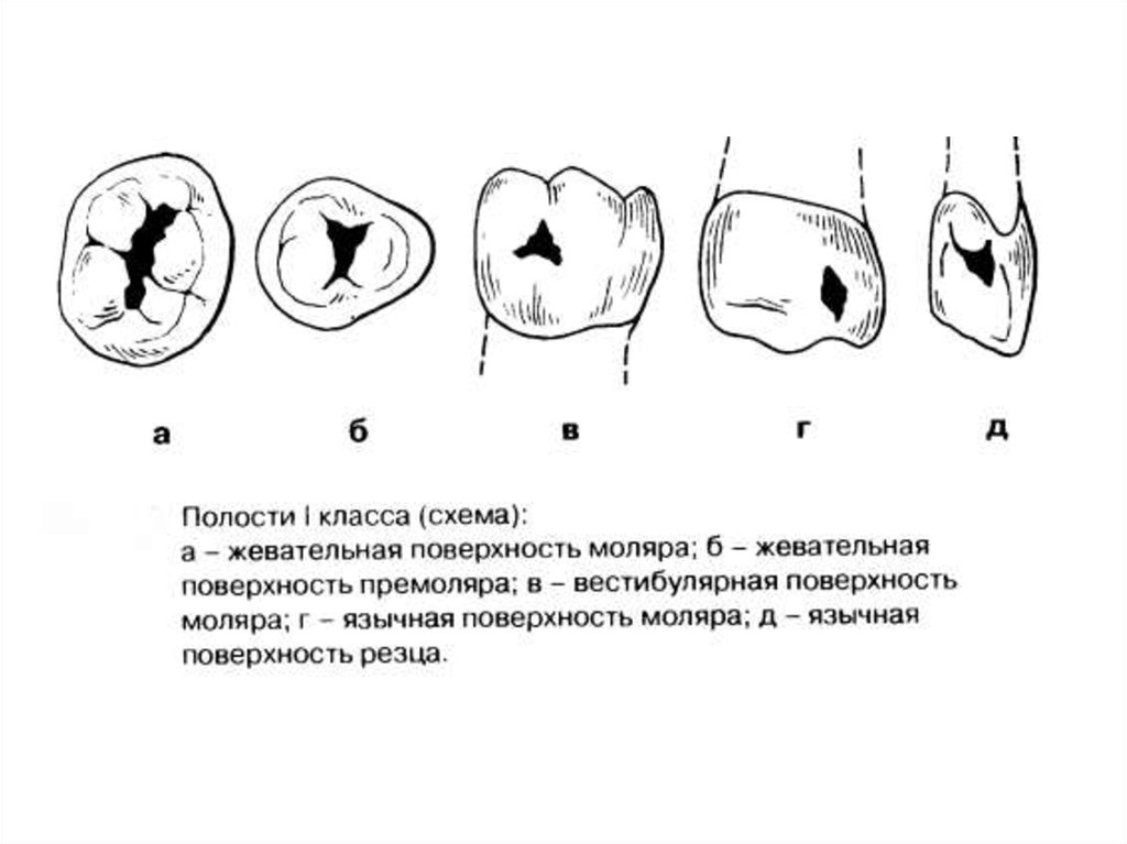 Классы по блэку. Классификация кариозных полостей по Блэку. Препарирование 1 класса по Блэку. Кариозная полость 1 класса по Блэку. Препарирование кариеса 1 класса.