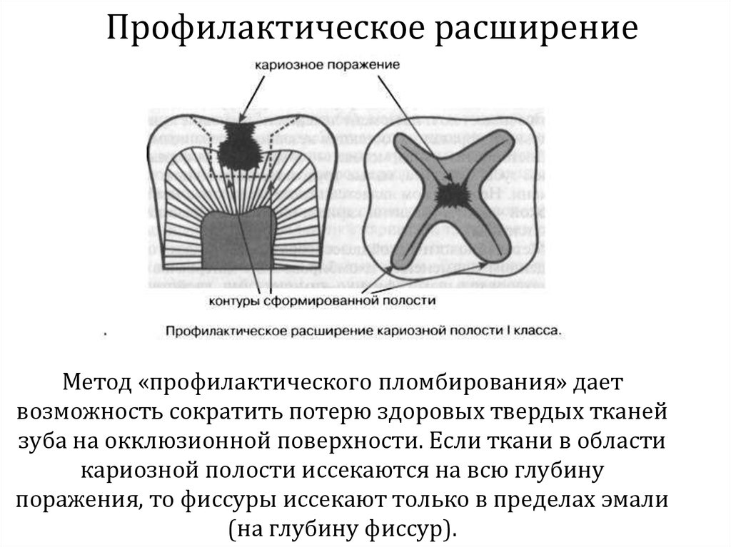 Полость расширена. Метод профилактического расширения кариозной полости. Метод профилактического расширения кариозной полости предложил. Препарирование полости по методу Блэка. Профилактическое расширение кариозной полости.