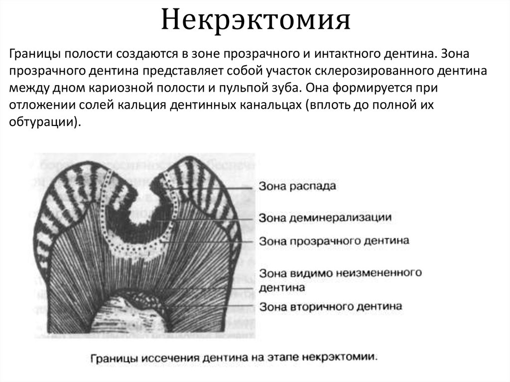 Полости 1. Некрэктомия кариозной полости. Зоны дна и краев кариозной полости. Некротомия и некрэктомия.