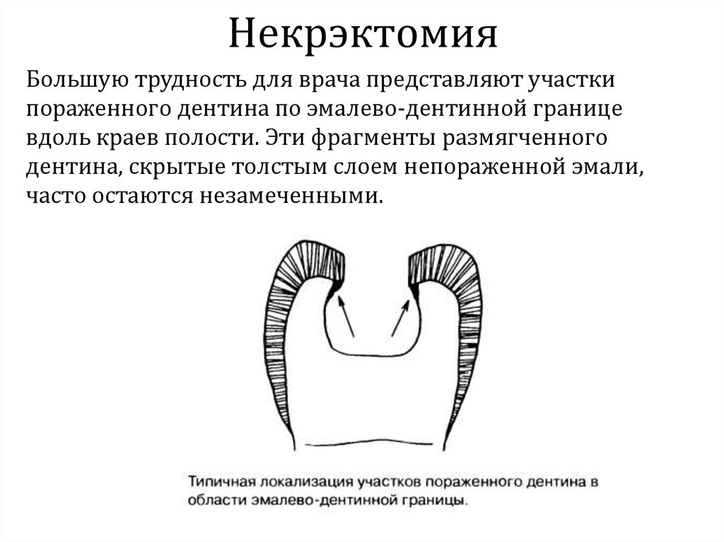 Полость применение. Некрэктомия (ранняя и отсроченная).. Этапы препарирования кариозных полостей 1 класса. Препарирование кариозной полости по 1 классу.