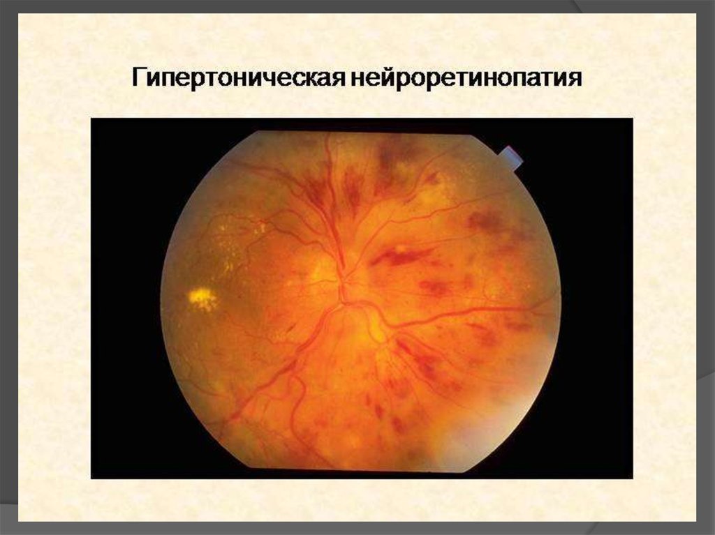 Изменение на глазном дне. Ангиопатия сетчатки глазное дно. Гипертоническая ретинопатия глаз. Гипертоническая ангиопатия сетчатки. Гипертоническая ретинопатия 1 стадия.