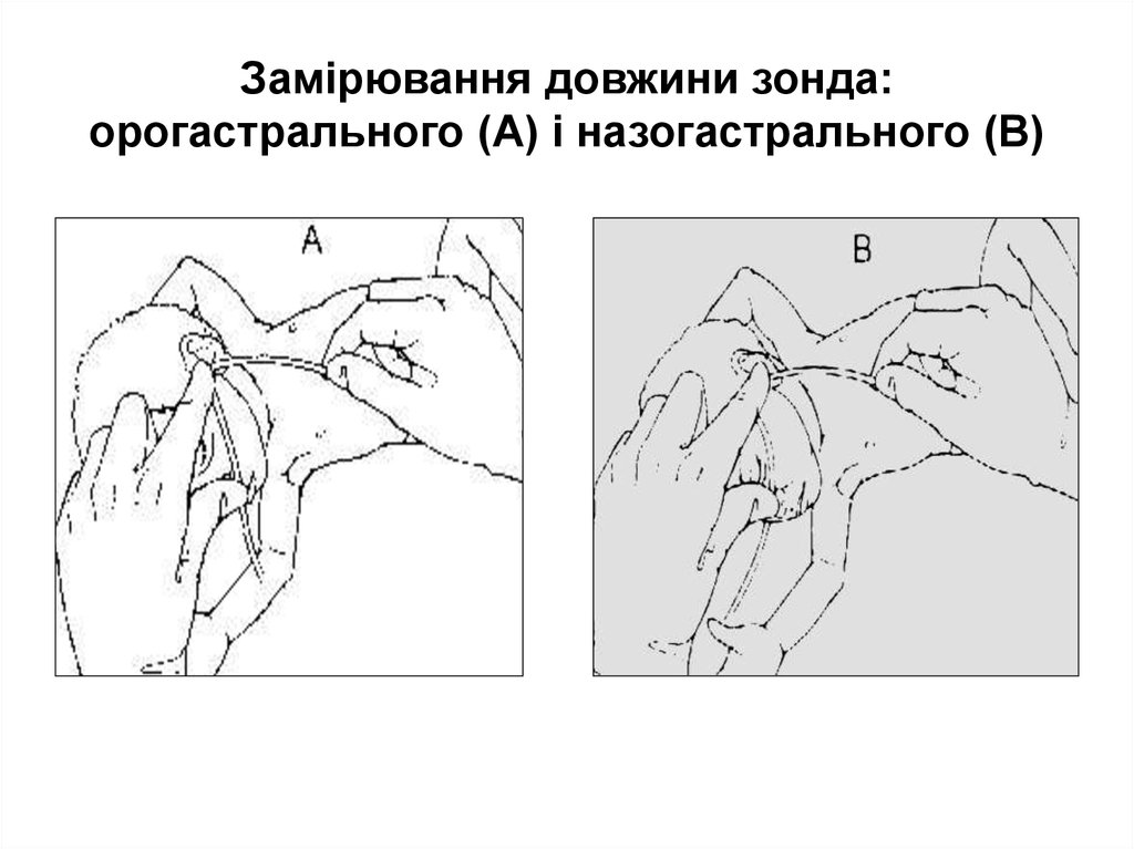 Выпадение назогастрального зонда карта вызова