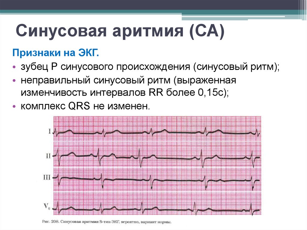 Что значит синусовый ритм сердца на экг. Синусовая аритмия ЭКГ признаки. ЭКГ критерии синусовой аритмии. Синусовая аритмия на ЭКГ расшифровка. Расшифровка ЭКГ сердца синусовый ритм норма.