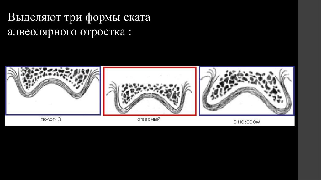 Альвеолярный гребень нижней. Форма ската альвеолярного отростка. Формы вестибулярного ската альвеолярных отростков. Атрофия альвеолярного отростка классификация. Оральный Скат альвеолярного отростка.