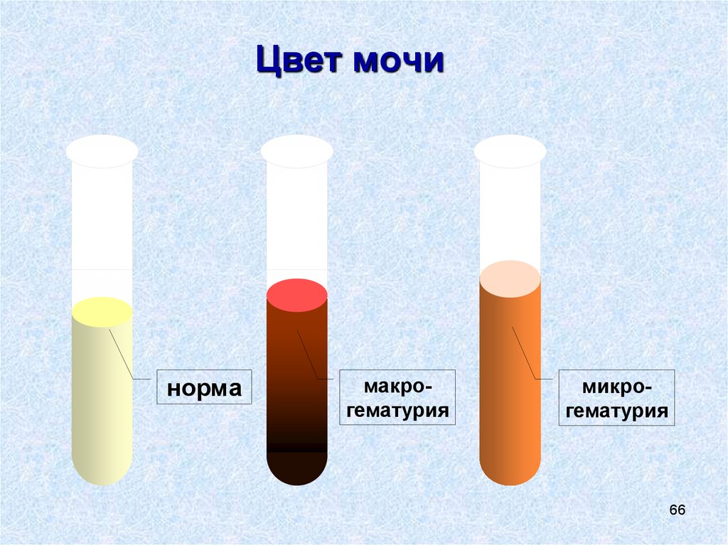 Норма цвета мочи. Макрогематурия и микрогематурия. Гемоглобинурия. Цвет мочи при макрогематурии.