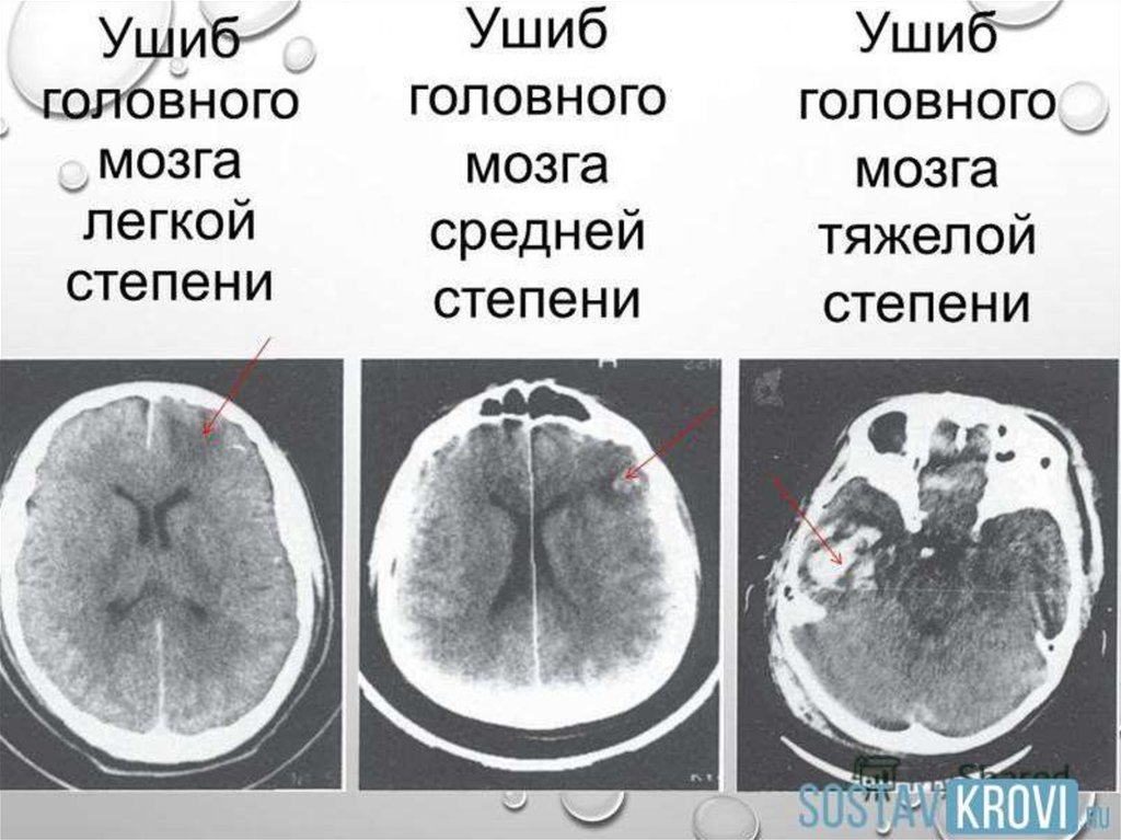 3 сотрясения мозга. Ушиб мозга легкой степени. Ушиб мозга средней степени. Ушиб головного мозга по степени тяжести. Кт признаки ушиба головного мозга легкой степени.