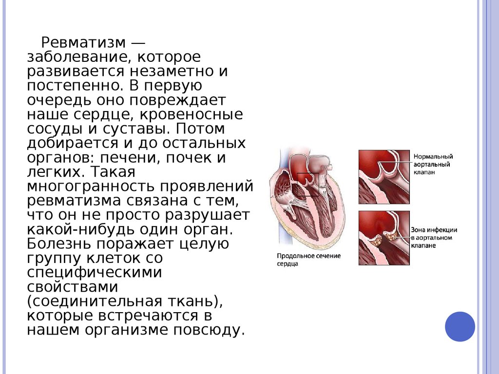 Ревматизм это простыми словами что за болезнь. Ревматическое поражение сердца. Заболевание сердца ревматизм.