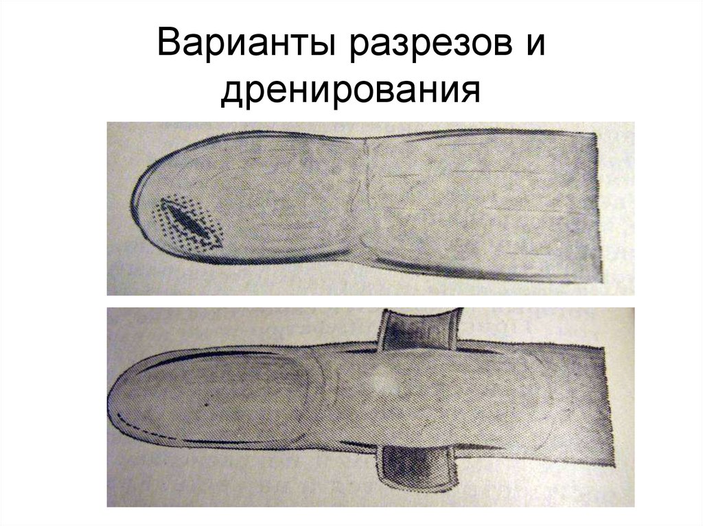 Варианты разрезов и дренирования