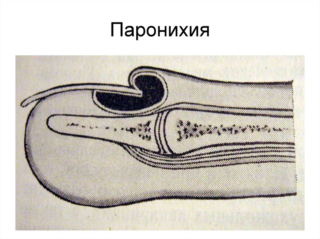 Ткани пальца. Околоногтевой панариций (паронихия). Стрептококковая паронихия. Паронихий панариций пандактилит.