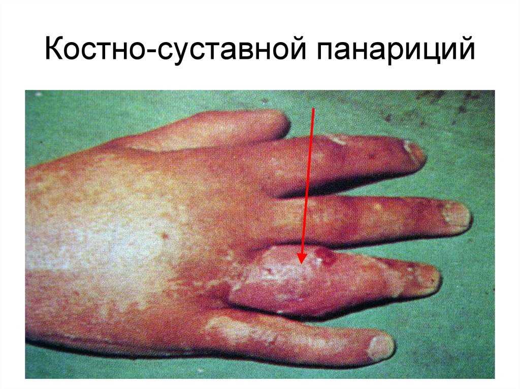 Костно-суставной панариций