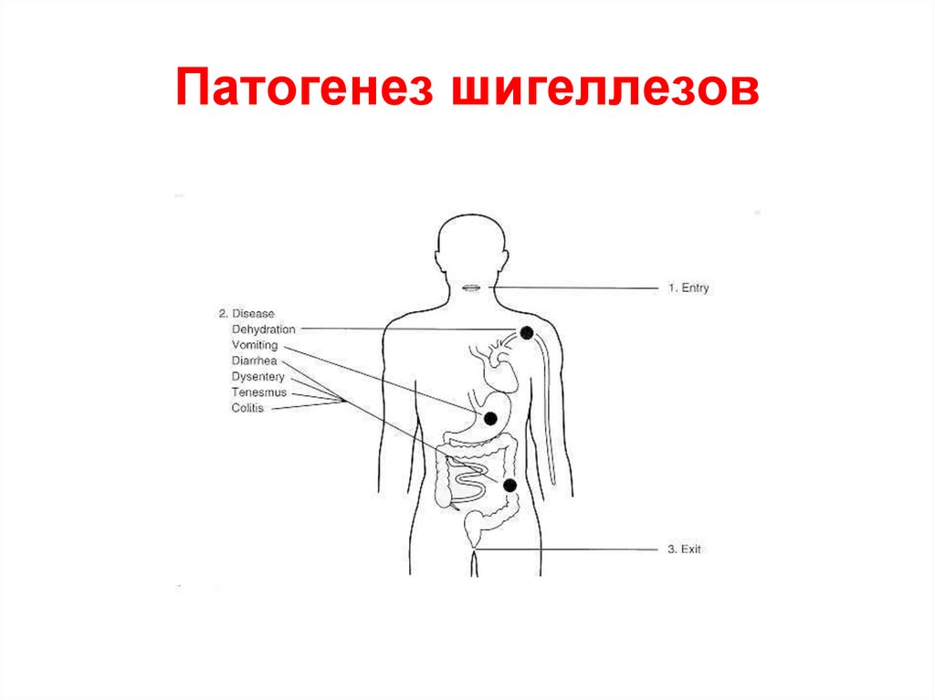 Патогенез дизентерии схема