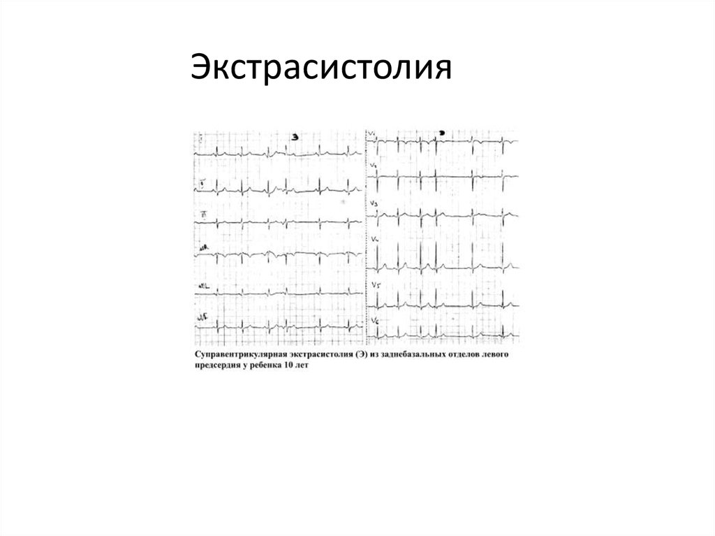 Экстрасистолия