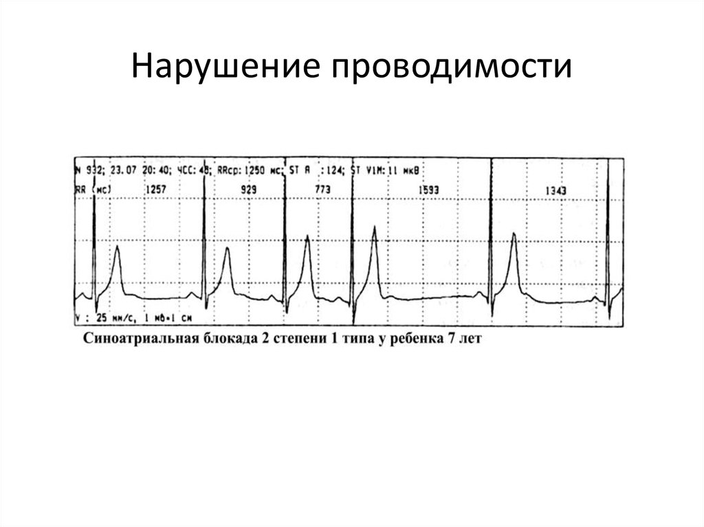 Нарушение проводимости