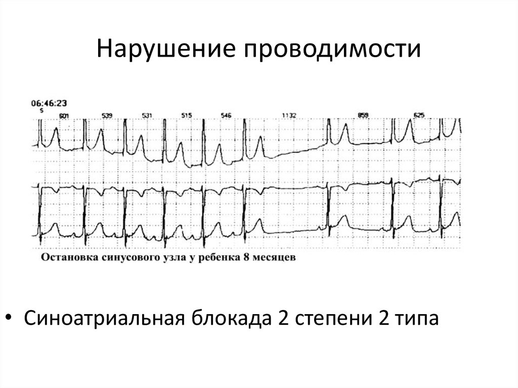 Нарушение проводимости