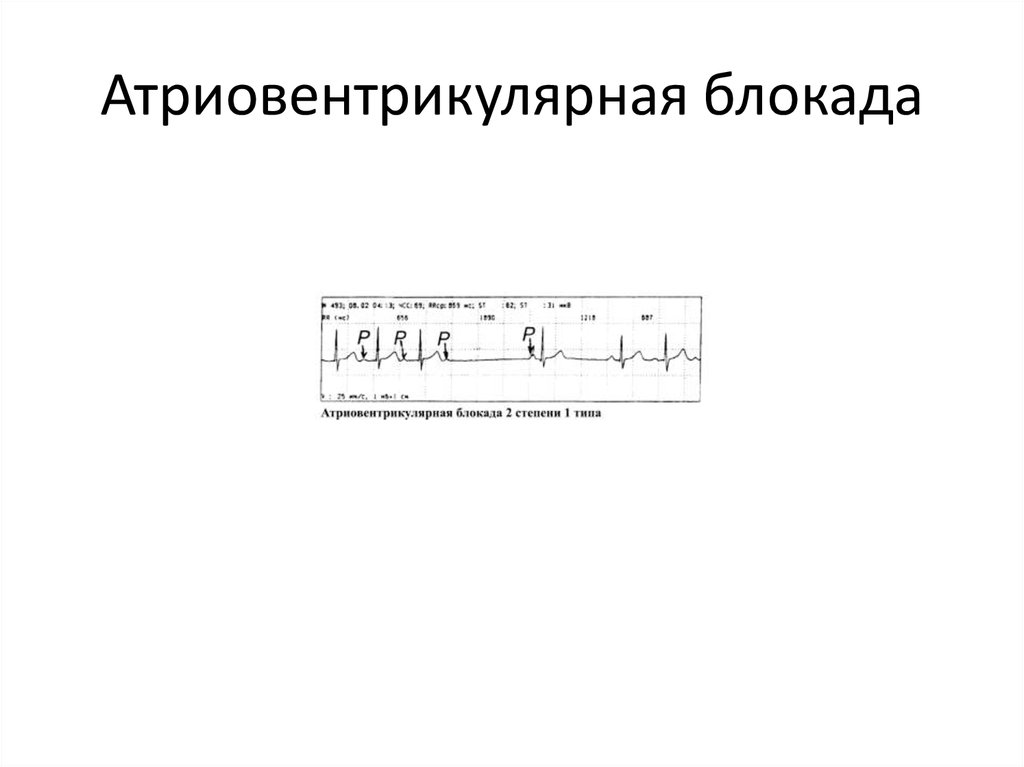Атриовентрикулярная блокада