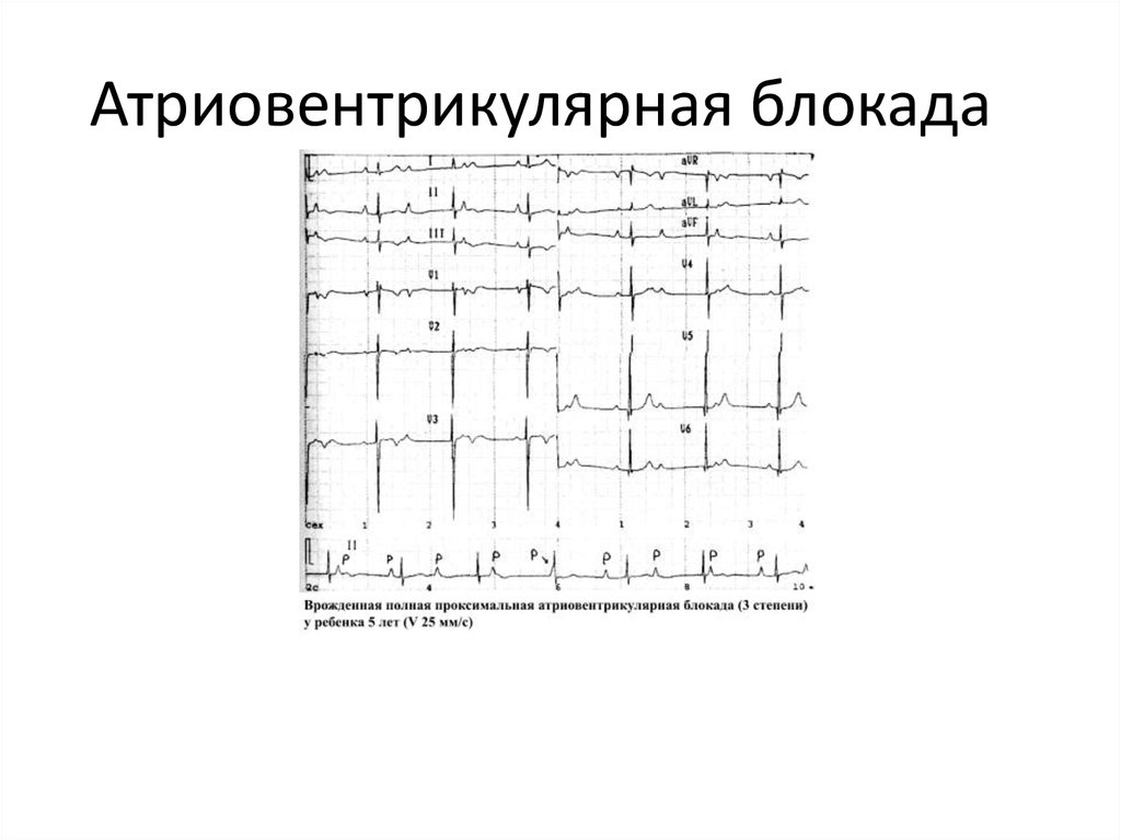 Атриовентрикулярная блокада