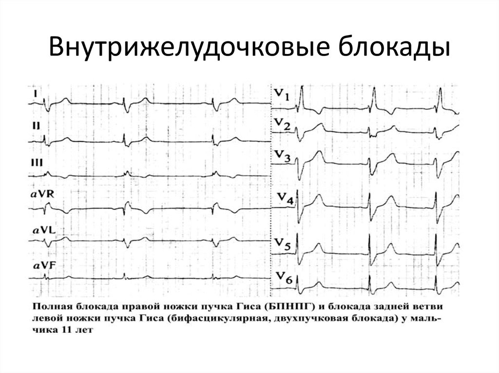 Внутрижелудочковая проводимость на экг что это. Внутрижелудочковые блокады на ЭКГ. ЭКГ при внутрижелудочковых блокадах. ЭКГ желудочковая блокадой ножек пучка Гиса. Полная внутрижелудочковая блокада на ЭКГ.