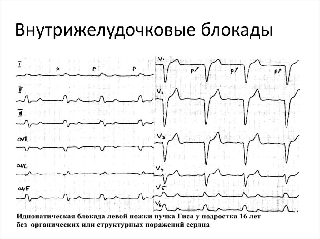 Местная внутрижелудочковая блокада: суть процедуры и ее …