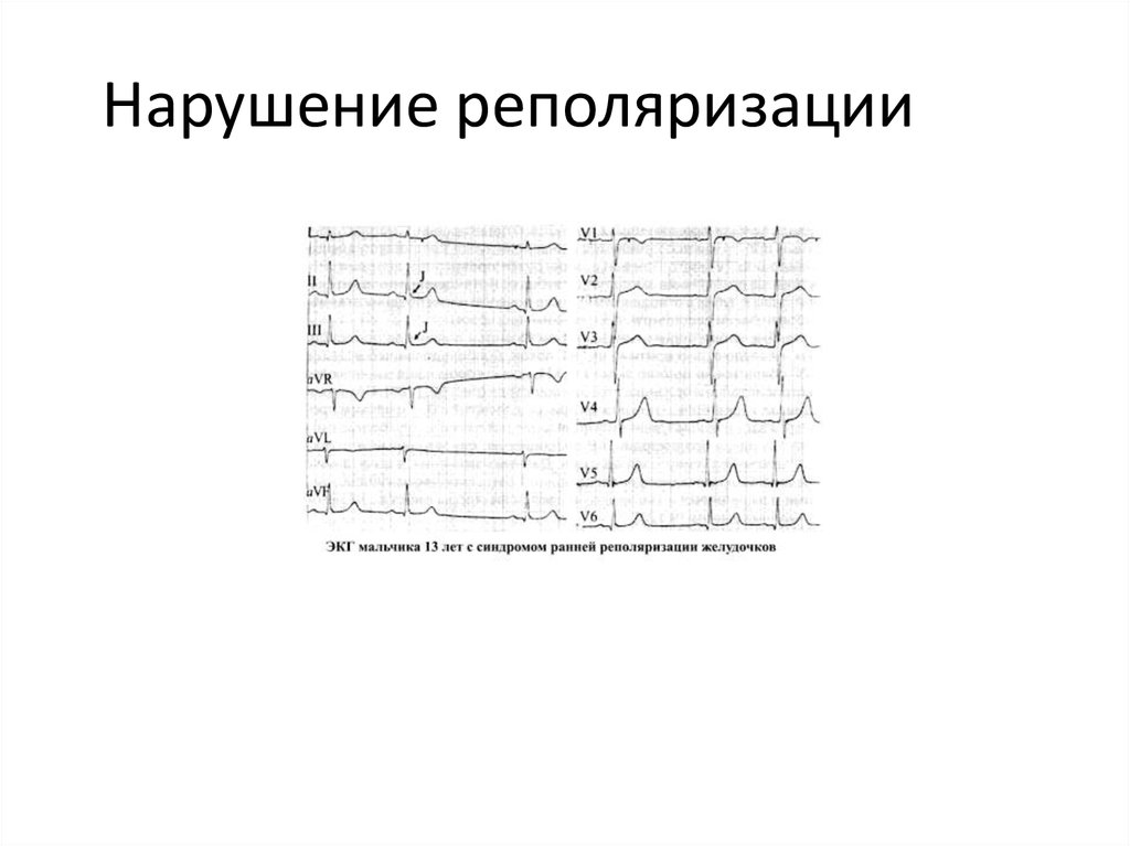 Диффузное нарушение процесса реполяризации сердца. Реполяризация миокарда желудочков ЭКГ. Реполяризационные изменения на ЭКГ. ЭКГ синдром изменений процессов реполяризации классификация. Заключение на ЭКГ синдром ранней реполяризации.