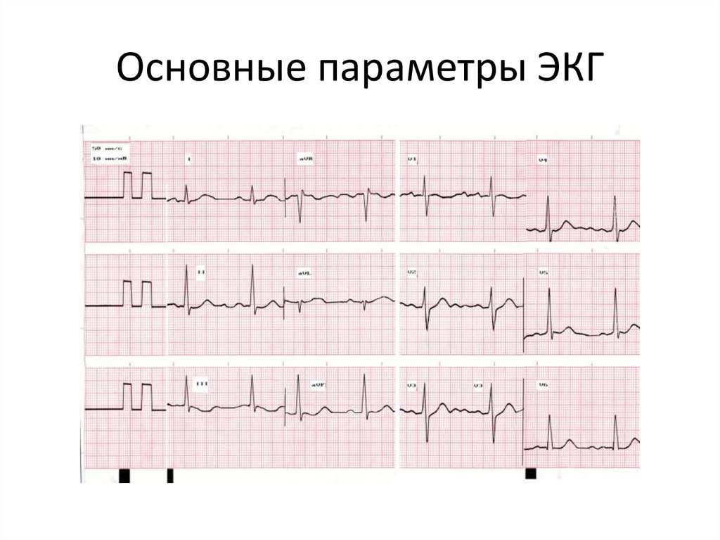 Экг диагностика. Параметры ЭКГ. Основные временные параметры ЭКГ. Основные диагнозы на ЭКГ. Основное параметры ЭКГ.