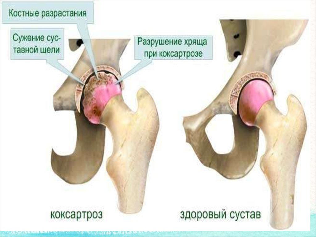 При коксартрозе тазобедренного сустава не рекомендуется. Вывих бедра на латинском.