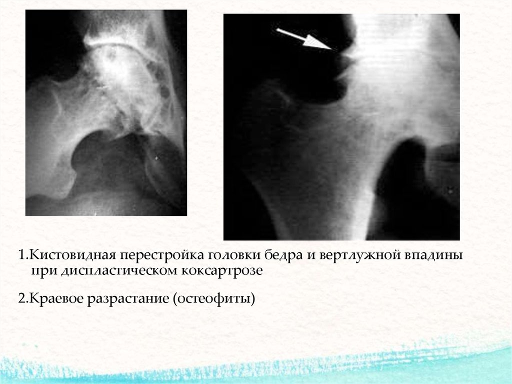 Остеофиты вертлужной впадины