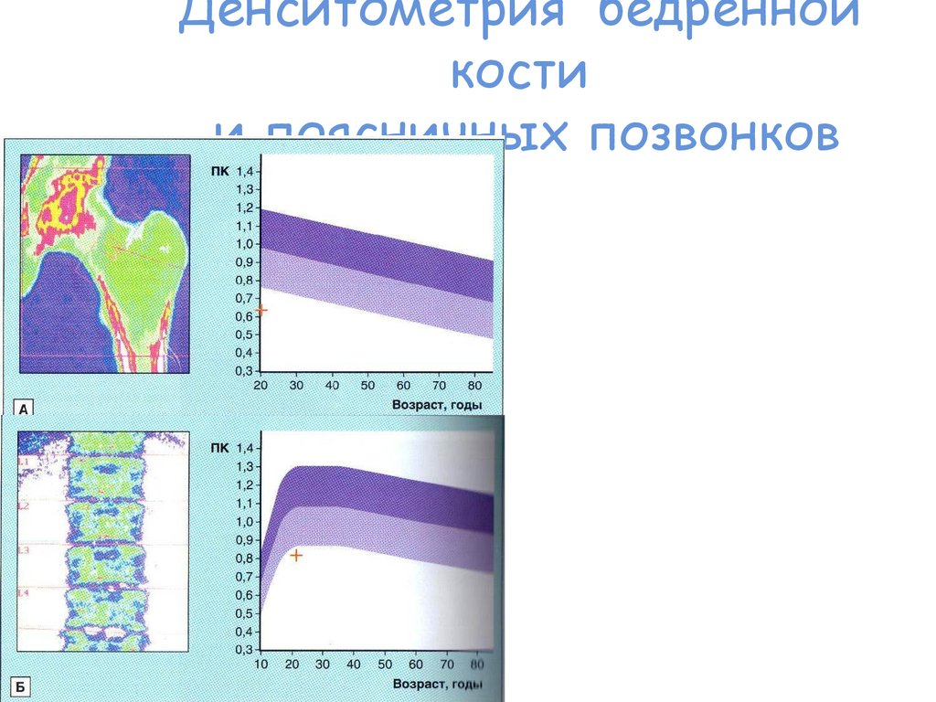 Денситометрия бедра и позвоночника