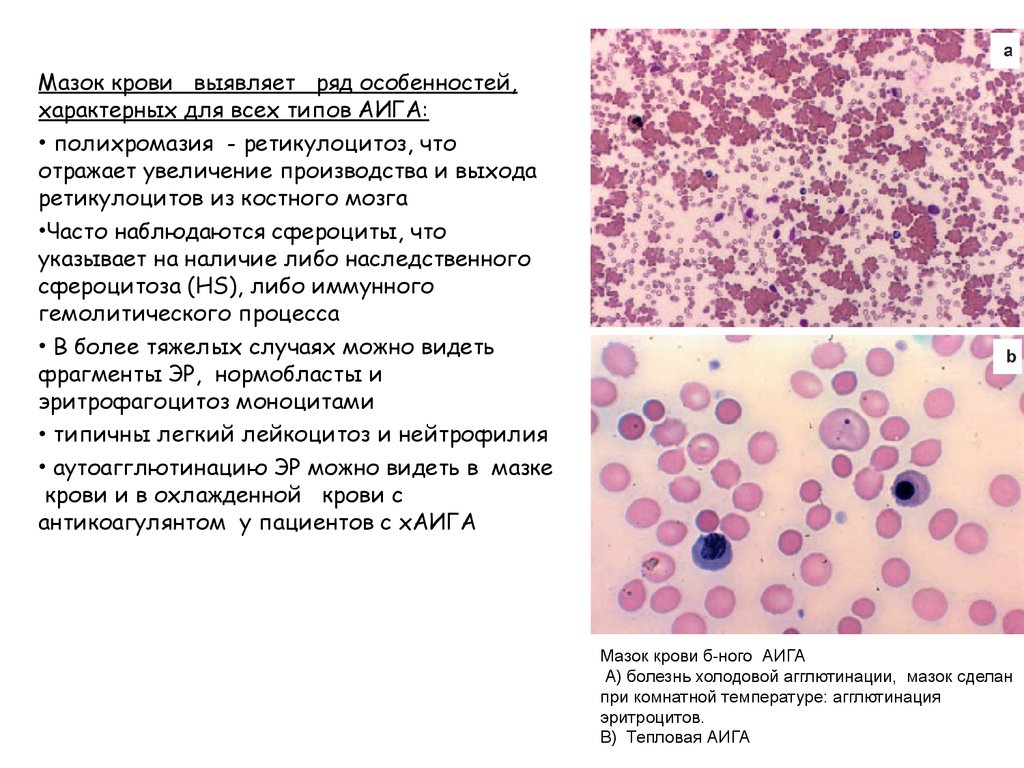 Эритроциты в мазке. Гемолитическпя Анимия картина крови. Гемолитическая анемия клетки крови. Гемолитическая анемия ретикулоцитоз. Гемолитическая анемия мазок крови.