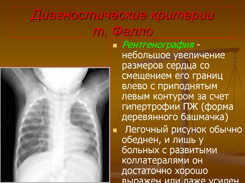 Границы расширены влево. Увеличение размеров сердца. Сердце в виде деревянного башмачка на рентгенограмме. Увеличение сердца в размерах влево -. Фалло рентген.