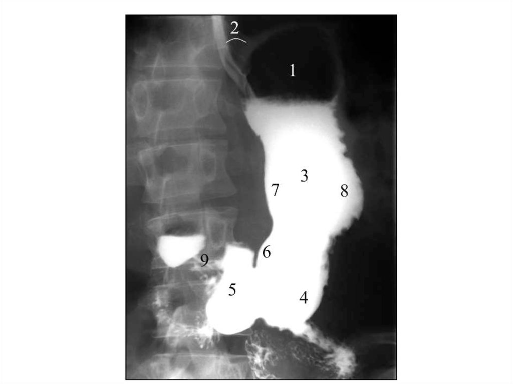 Рентген с барием москва. Рентген двенадцатиперстной кишки. Рентгеноанатомия 12 перстной кишки. Стеноз кардиального отдела желудка рентген. Рентгенологическое исследование желудка в норме.