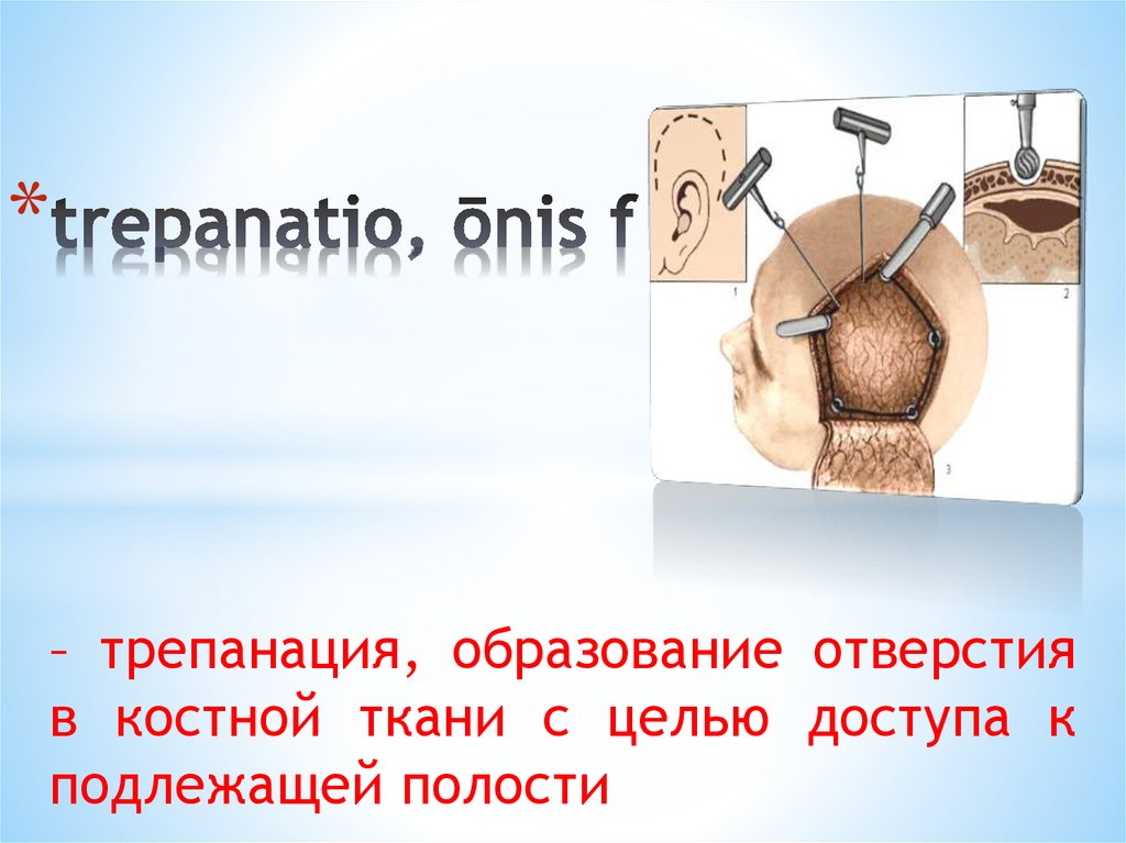 trepanatio, ōnis f