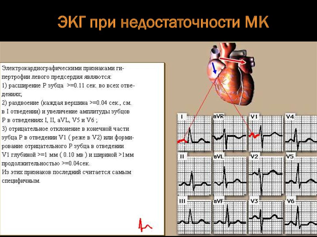 Недостаточность предсердия. Хроническая ревматическая болезнь сердца ЭКГ. Симптомы порока сердца на ЭКГ. ЭКГ В норме и при митральной недостаточности. ЭКГ критерии хронической коронарной недостаточности.