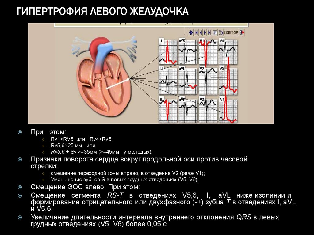 Миокард левого предсердия. Гипертрофия миокарда левого желудочка на ЭКГ. Конфигурации сердца при гипертрофии лж. Гипертрофия папиллярных мышц левого желудочка сердца. Максимальная гипертрофия левого желудочка отмечается при.