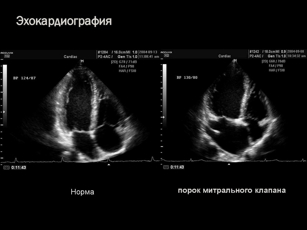 Эхокардиография сердца презентация