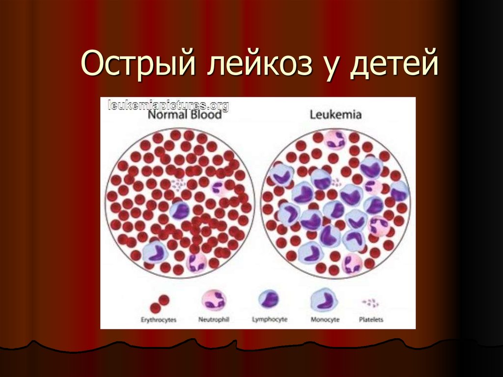 Острый лимфолейкоз презентация