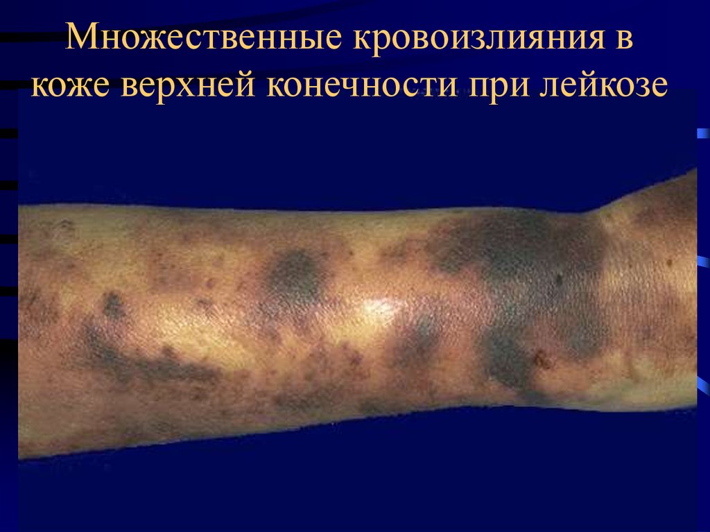 Множественные кровоизлияния в коже верхней конечности при лейкозе