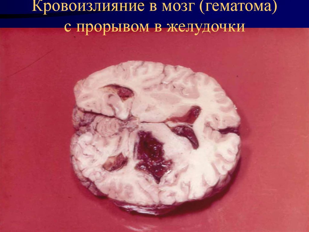 Кровоизлияние в мозг (гематома) с прорывом в желудочки