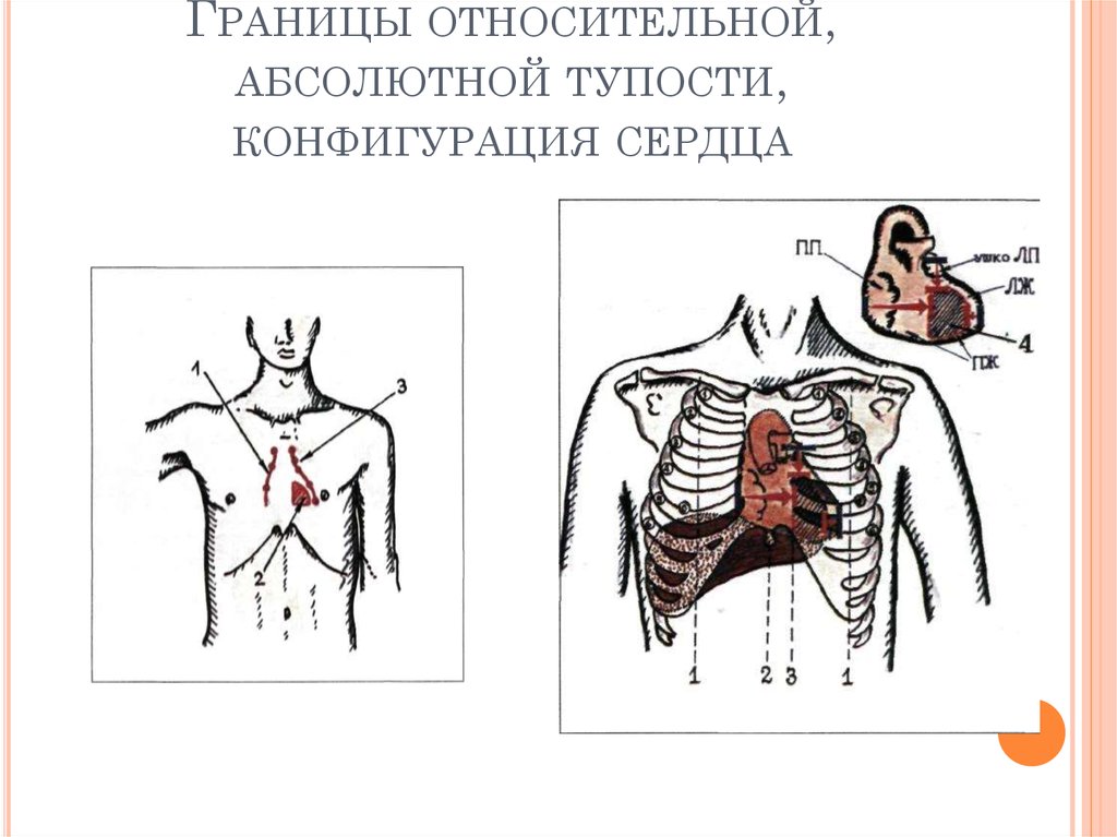 Определение границ сердечной тупости. Верхняя граница относительной тупости сердца. Методика определения границ относительной тупости сердца. Границы относительной и абсолютной тупости. Границы абсолютной тупости сердца.