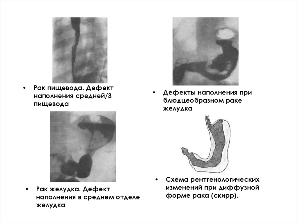 3 пищевода. Доброкачественная опухоль желудка схема рентген. Доброкачественные опухоли желудка схема. Дефект наполнения пищевода рентген. Непроходимость пищевода рентген.