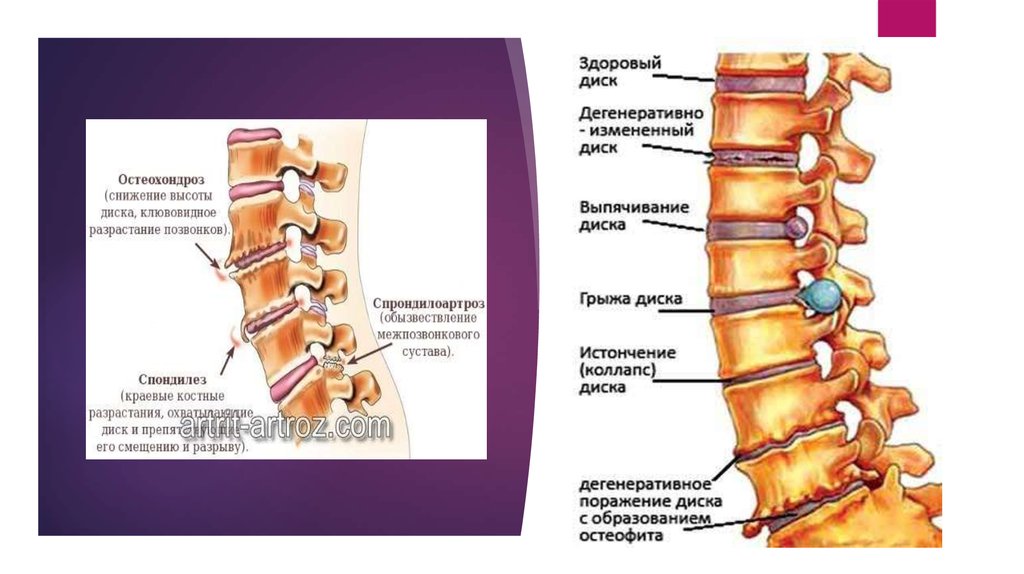 Дистрофические изменения позвоночника что это