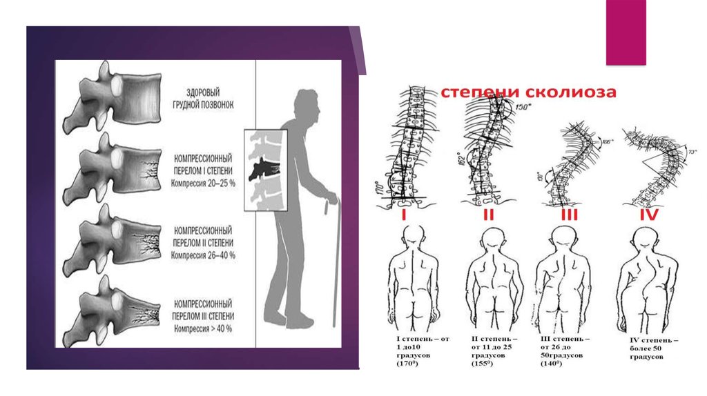 Сколиоз позвоночника презентация травматология